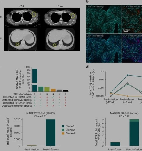 Case study from a new trial with systematic #immune_response analyses